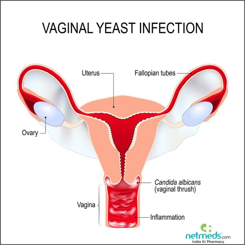 Yeast Infection Vs Bacterial Vaginosis Mmegi Online